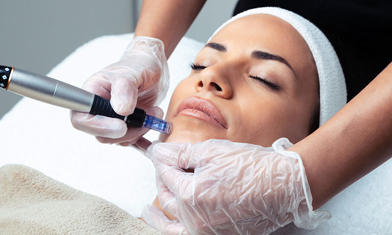 Read more about the article Microneedling
